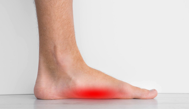 Propadlá klenba není jen estetickým problémem. Ovlivňuje chůzi i celé tělo