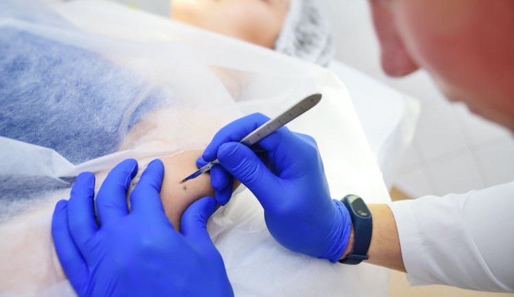 Nechte si po létu zkontrolovat znaménka, doporučují dermatologové.