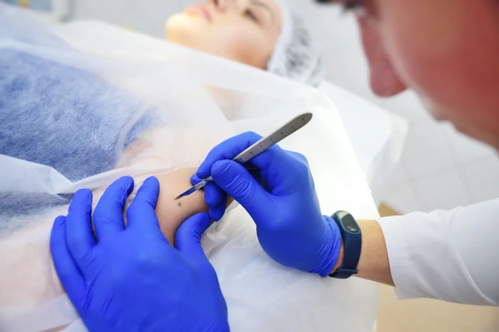 Nechte si po létu zkontrolovat znaménka, doporučují dermatologové.