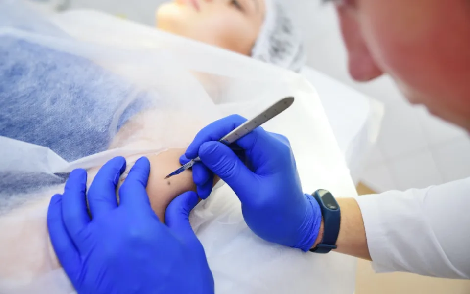 Nechte si po létu zkontrolovat znaménka, doporučují dermatologové.